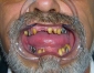 Izbruceni zubi